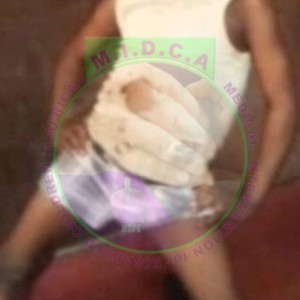 Godwin Bowed legs