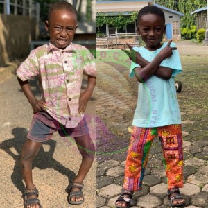 Bilateral Bowed Legs