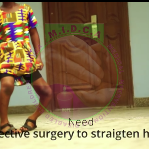 Emmanuella's Bilateral Bowed leg