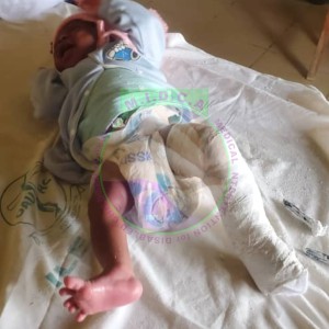 Gbadebo Okikiola Left unilateral club foot
